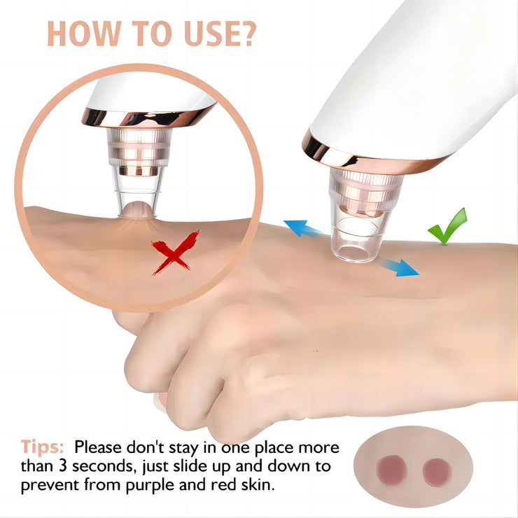 Limpiador de poros al vacío con tecnología más reciente para eliminar puntos negros en el rostro y la nariz, kit de eliminación de puntos negros, herramienta eléctrica para extraer acné facial