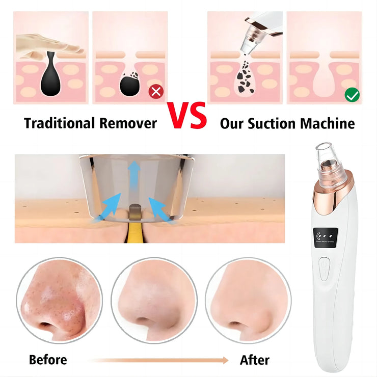 Newest Technology Blackhead Remover Vacuum Pore Cleaner for Face&Nose Blackhead Removal Kit Electric Acne Facial Extractor Tool